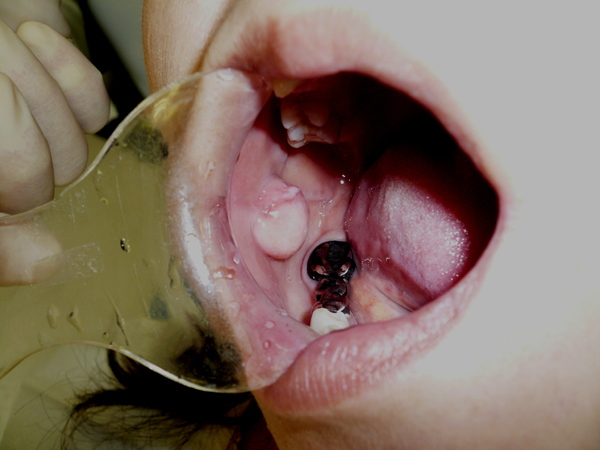 しこり 中 口 の こんな症状が実は病気のサイン？：口腔内の異変と早期発見・治療の重要性｜口腔がん検診・舌がん検診予約を歯科医院で