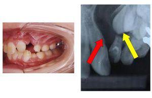 顎裂部骨移植術イメージ01