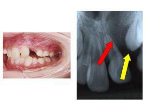 顎裂部骨移植術イメージ02