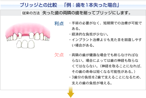 ブリッジとの比較　「例：歯を１本失った場合」