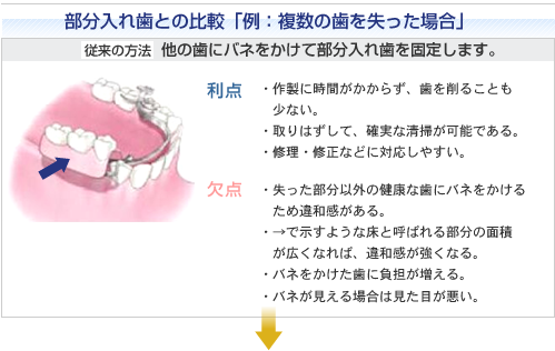 部分入れ歯との比較「例：複数の歯を失った場合」