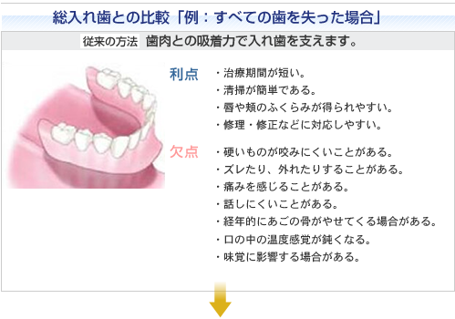 総入れ歯との比較「例：すべての歯を失った場合」