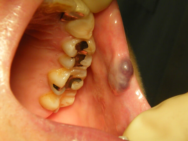 非歯原性腫瘍02