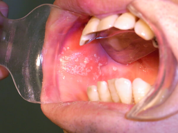 口腔カンジダ症01