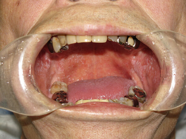 口腔カンジダ症02