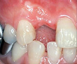 歯の欠損が少ない場合01