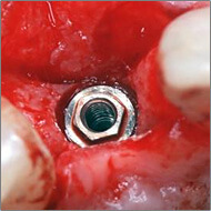 歯の欠損が少ない場合02