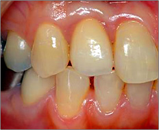 歯の欠損が少ない場合03