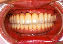 歯の欠損が多い場合03