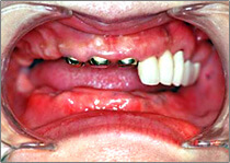 歯の欠損が多い場合01