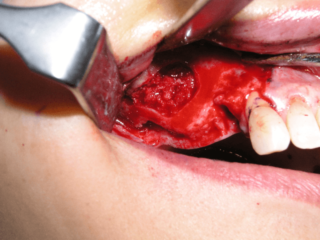 歯の欠損が多い場合05