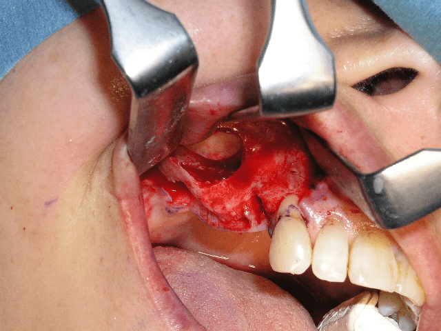 歯の欠損が多い場合06