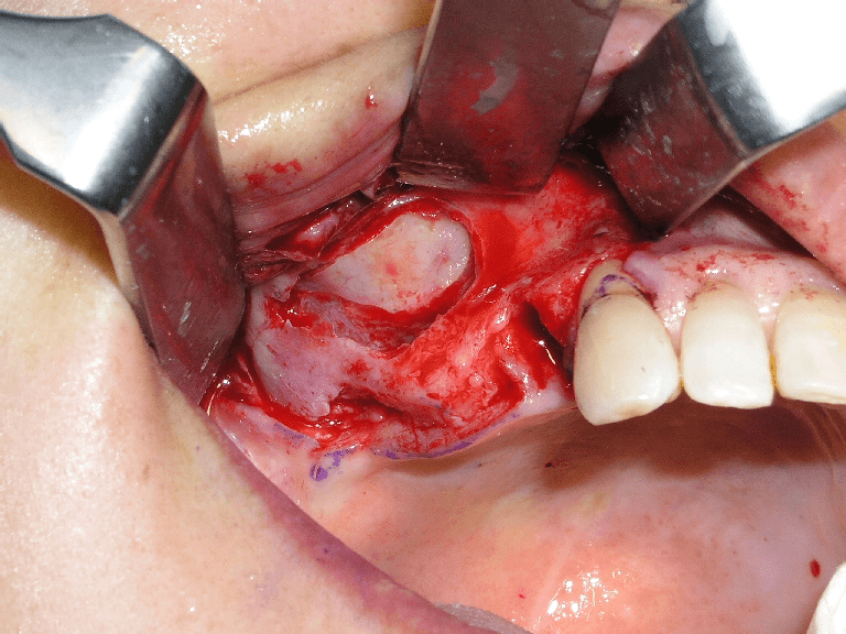 歯の欠損が多い場合04