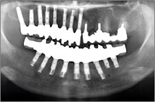 歯の欠損が多い場合02