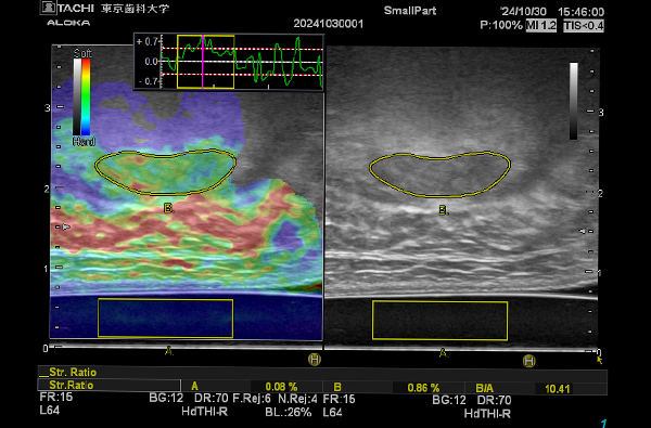 口腔健康科学講座 摂食嚥下リハビリテーション研究室の研究
