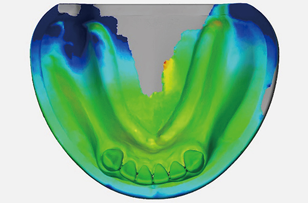 パーシャルデンチャー補綴学講座の研究