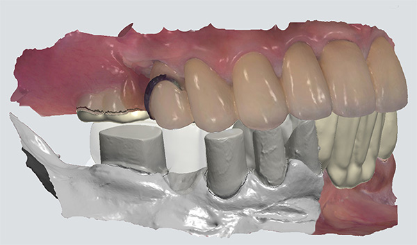 パーシャルデンチャー補綴学講座の臨床