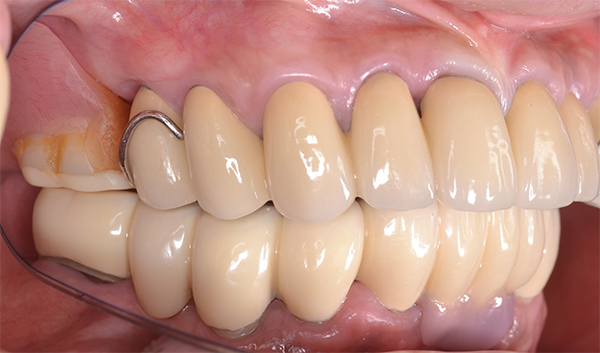 パーシャルデンチャー補綴学講座の臨床