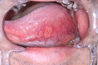 早期舌癌　術前