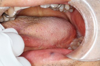 早期舌癌　舌部分切除，一次縫縮後