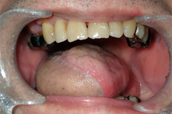 進行舌癌　舌半側切除、遊離皮弁再建