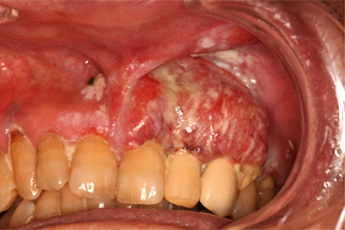上顎歯肉癌　術前