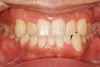 歯周病の治療イメージ2