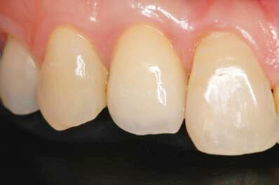 歯の欠損が少ない場合01