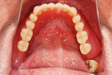 インプラントオーバーデンチャー03