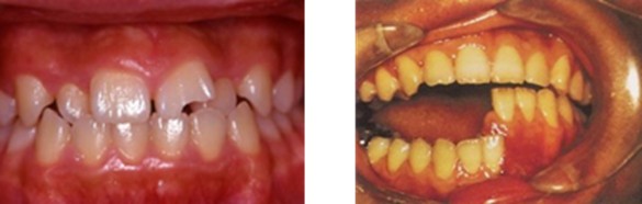 お口周囲の外傷予防・軽減