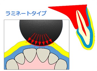 ラミネートタイプ02