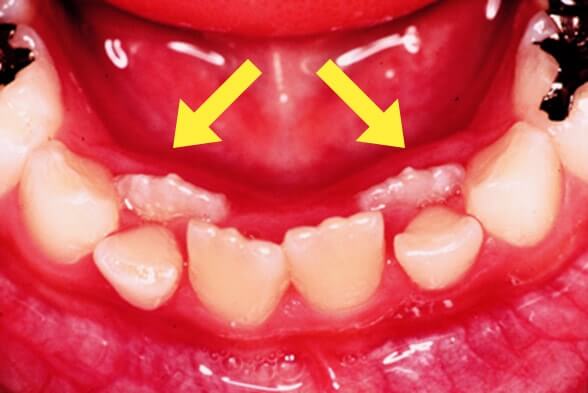 萌出異常(乳歯の裏から歯が生えてきた)