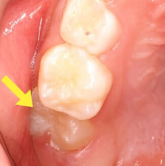 萌出異常(永久歯が乳歯に引っかかっている)01
