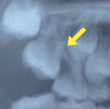 萌出異常(永久歯が乳歯に引っかかっている)02
