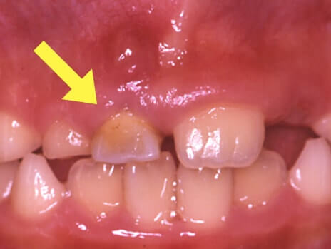 乳歯の晩期残存(乳歯がなかなか抜けない)01