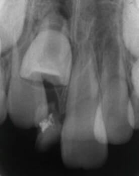 乳歯の晩期残存(乳歯がなかなか抜けない)02